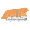 PM-01-11 Титановая ортодонтическая пластина удлиненная для интрузии верхних моляров, ретракции или верхней зубной дуги