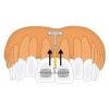 PM-01-03 Титановая ортодонтическая якорная пластина T-образная для интрузии передних верхних зубов
