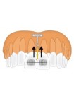PM-01-03 Титановая ортодонтическая якорная пластина T-образная для интрузии передних верхних зубов