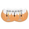 PM-01-04 Титановая ортодонтическая якорная пластина T-образная для интрузии передних нижних зубов