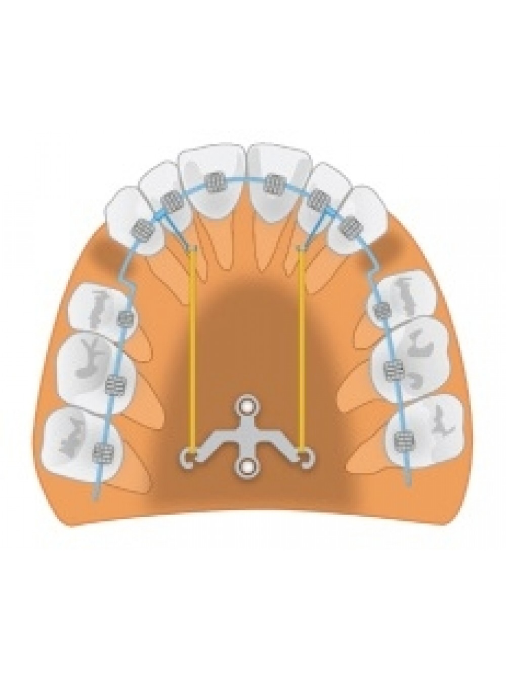 Верхняя пластина. Ортодонтические пластины МСТ. Якорные пластины ортодонтические. Титановая ортодонтическая пластина небная для ретракции передних. Аппарат для дистализации моляров.