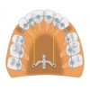 PM-01-02 Титановая ортодонтическая пластина небная для ретракции передних зубов в язычную сторону или для дистализации верхних моляров