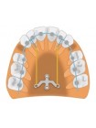 PM-01-02 Титановая ортодонтическая пластина небная для ретракции передних зубов в язычную сторону или для дистализации верхних моляров