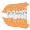 PM-01-05 Титановая ортодонтическая якорная пластина L-образная для интрузии моляров (ЛЕВАЯ)